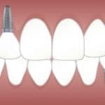 Prix implant dentaire Lyon